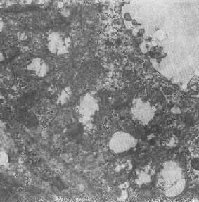 腎小管上皮細胞線粒體部分空泡變