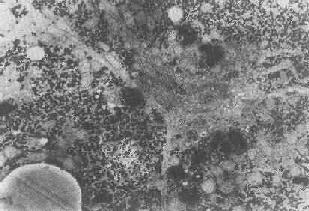 肝細胞內脂褐素顆粒殘存小體即終末溶酶體