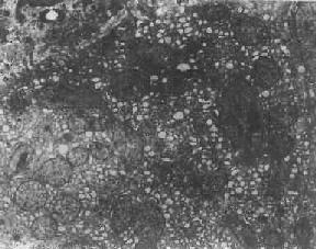 肝細胞光面內質網增生伴輕度擴大