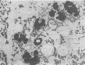 肝細胞內次級溶酶體