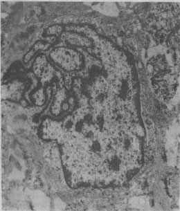 惡性腫瘤細胞的奇異形核