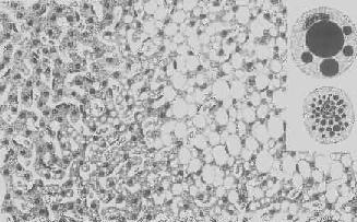 肝細(xì)胞脂肪變性