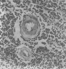 脾中央動(dòng)脈玻璃樣變