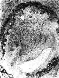 機(jī)化的血栓