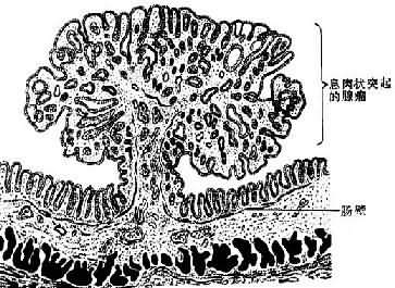 腸的息肉狀腺瘤模式圖