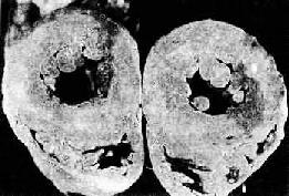 高血壓病時左心室向心性肥大(心臟橫斷面)