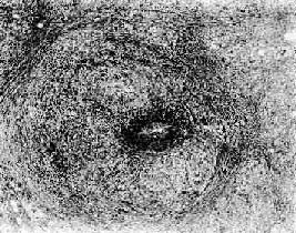 巨細胞性動脈炎