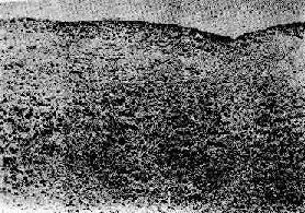 風(fēng)濕性心內(nèi)膜炎