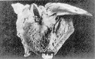 急性細菌性心內膜炎