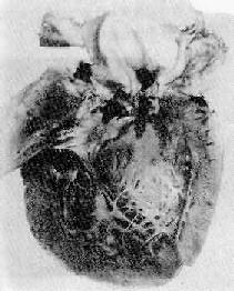 亞急性細菌性心內膜炎