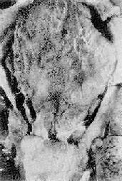 風(fēng)濕性心外膜炎